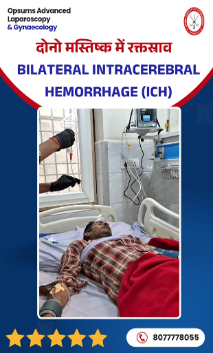 Bilateral-Intracerebral-Hemorrhage