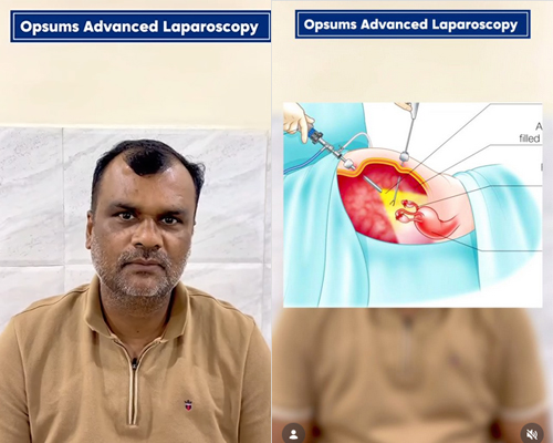 Total-Laparoscopic-Hysterectomy